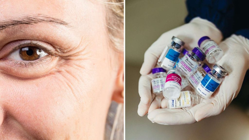 Wat doet botox tegen kraaienpootjes