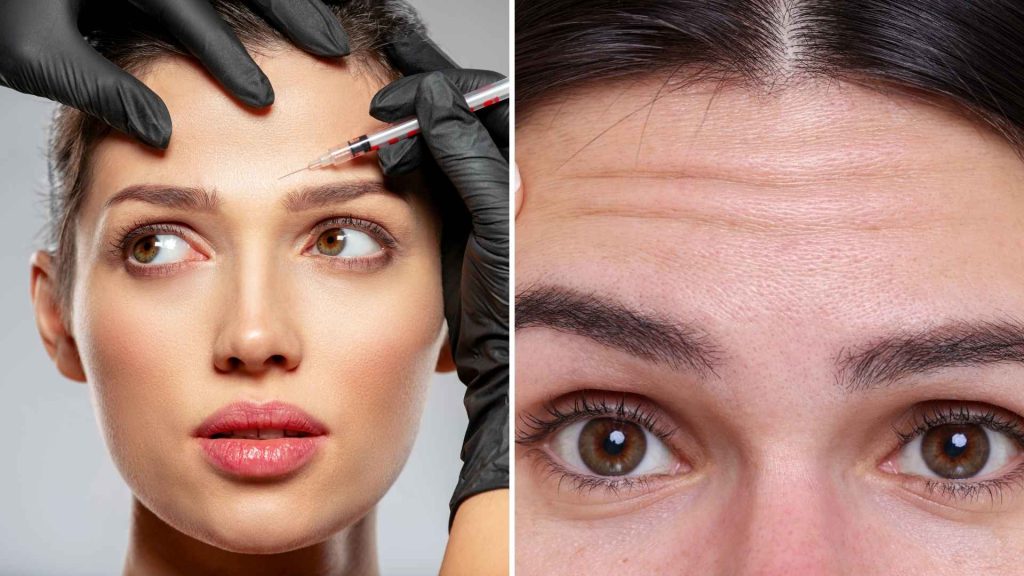 Wat doet botox tegen voorhoofdsrimpels