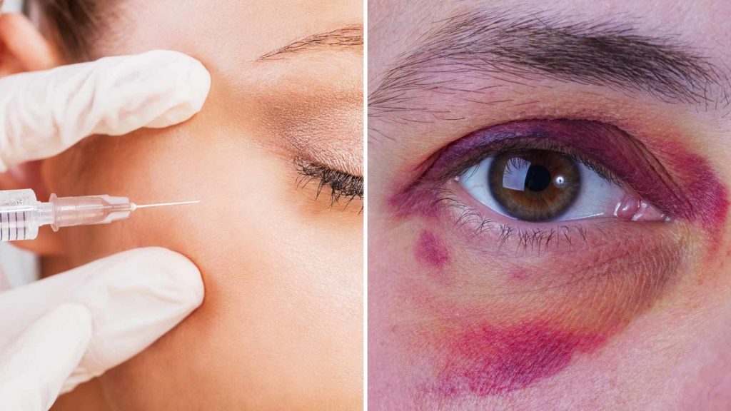 Wat te doen bij blauwe plekken na injectables