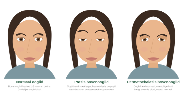 Vergelijking van een normaal bovenooglid, ptosis en dermatochalasis